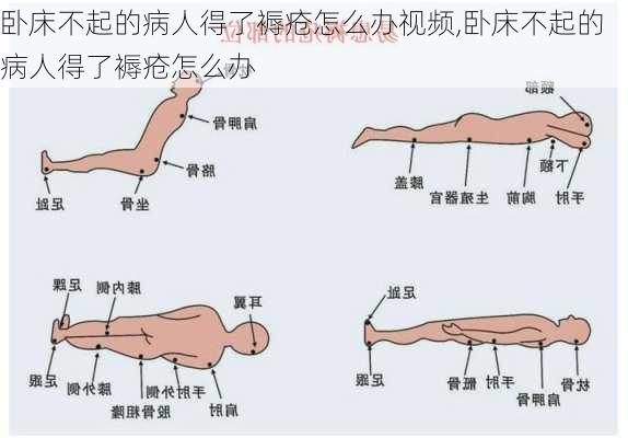 卧床不起的病人得了褥疮怎么办视频,卧床不起的病人得了褥疮怎么办