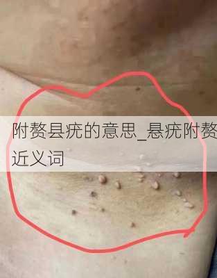 附赘县疣的意思_悬疣附赘近义词